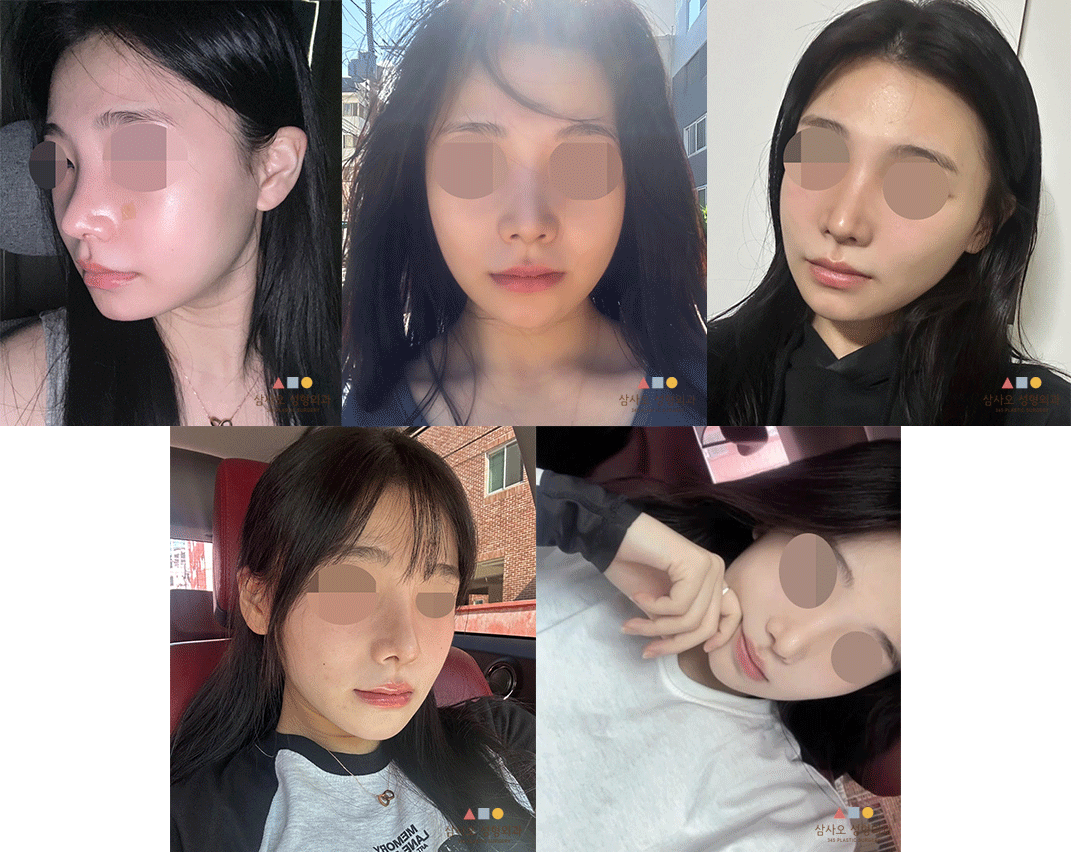 수술 후