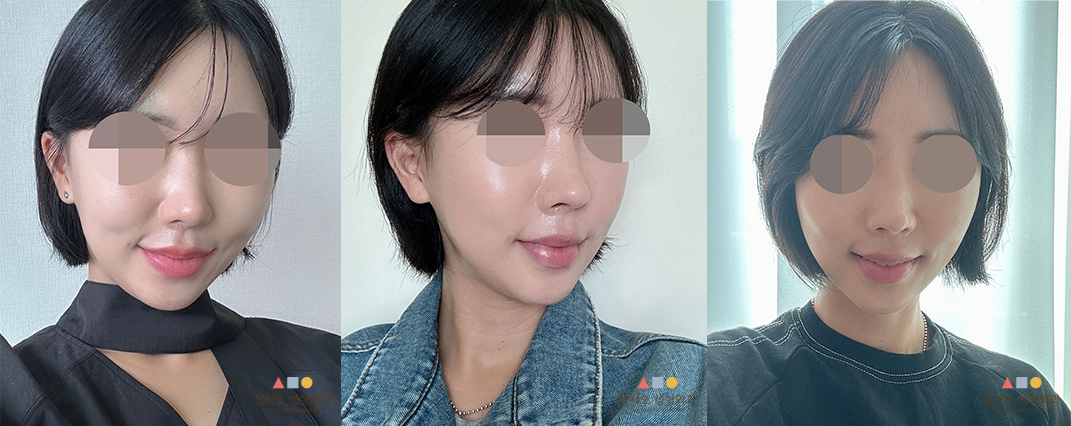 수술 후
