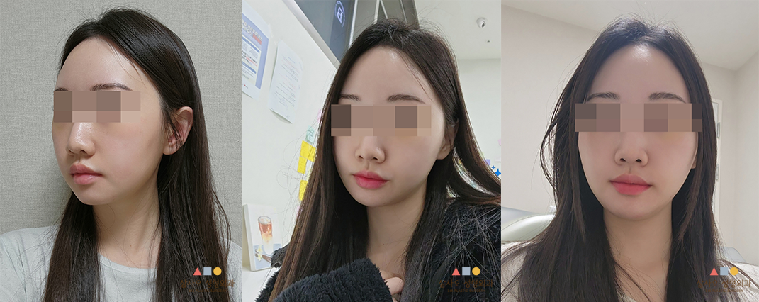 수술 후