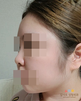수술 전
