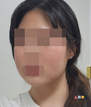 수술 후