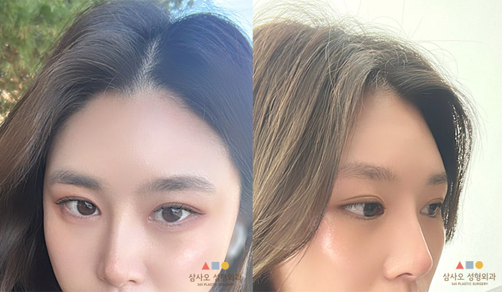 수술 후
