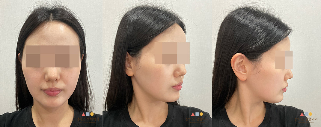 수술 후