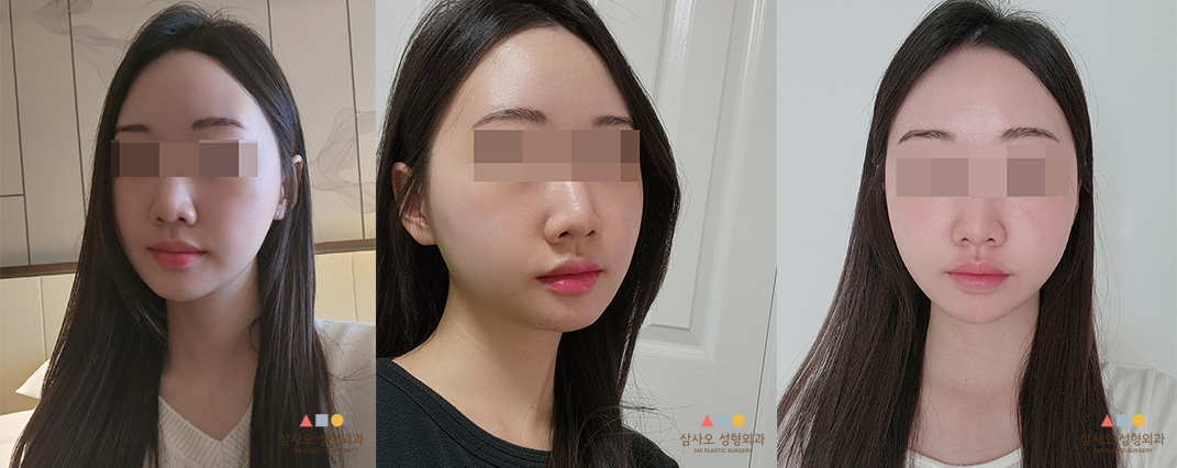 수술 후