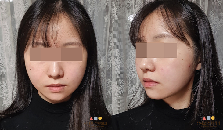 수술 후