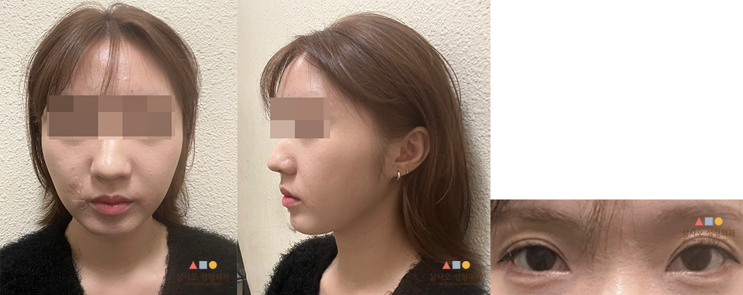 수술 후