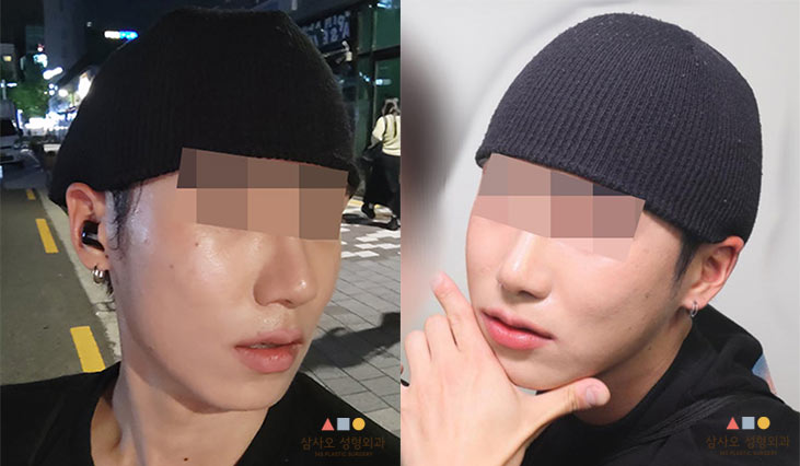 수술 후