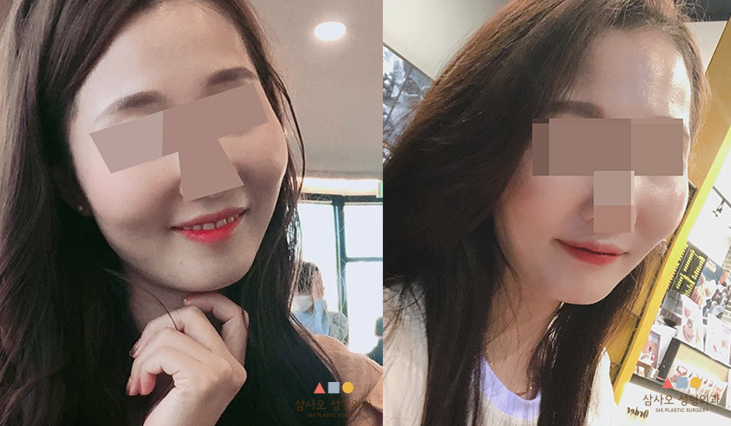 수술 전