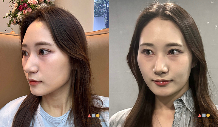 수술 전