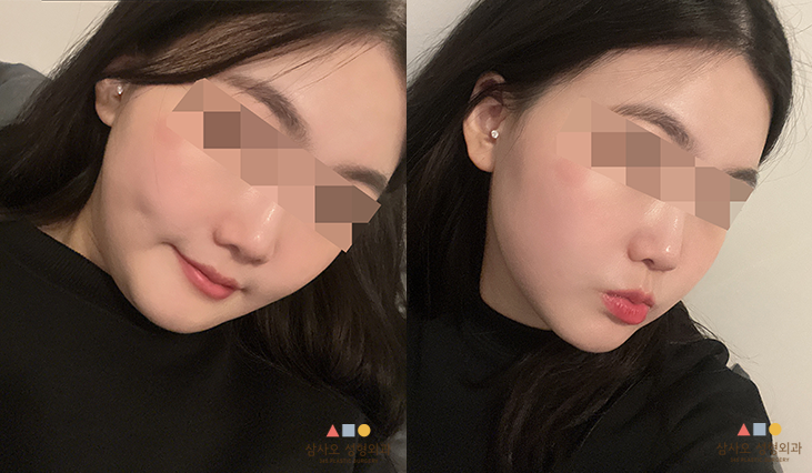 수술 후