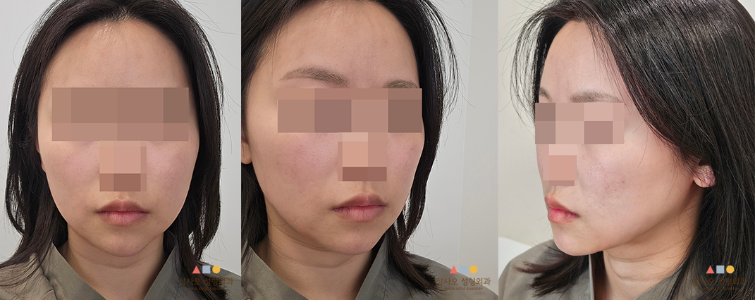 수술 전