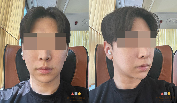 수술 후