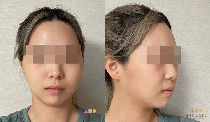 수술 후