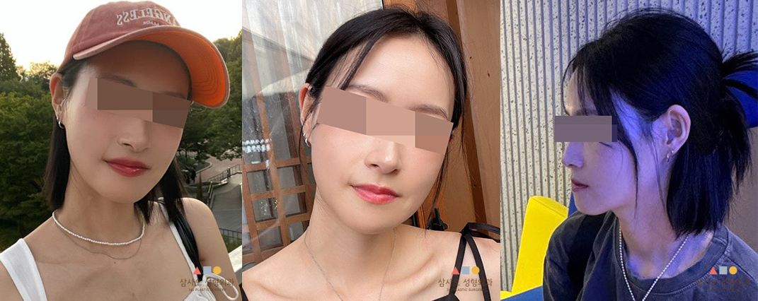 수술 후