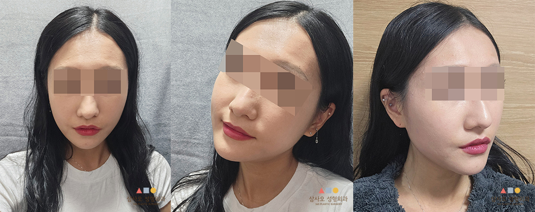 수술 후