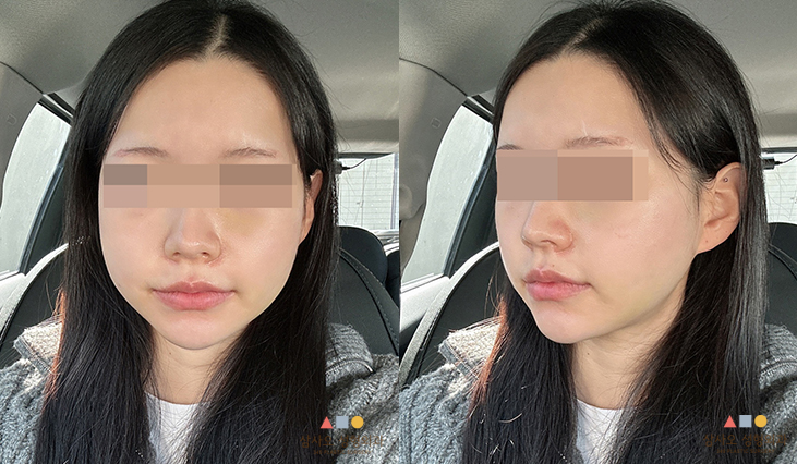수술 후