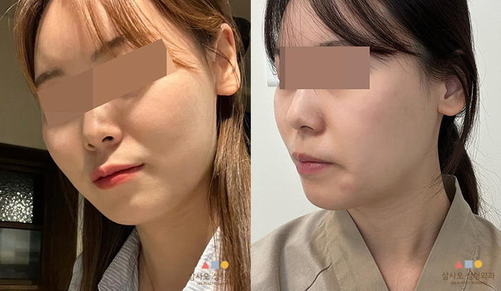 수술 전