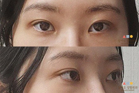 수술 후