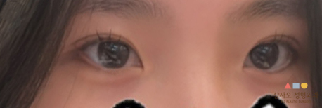 수술 후