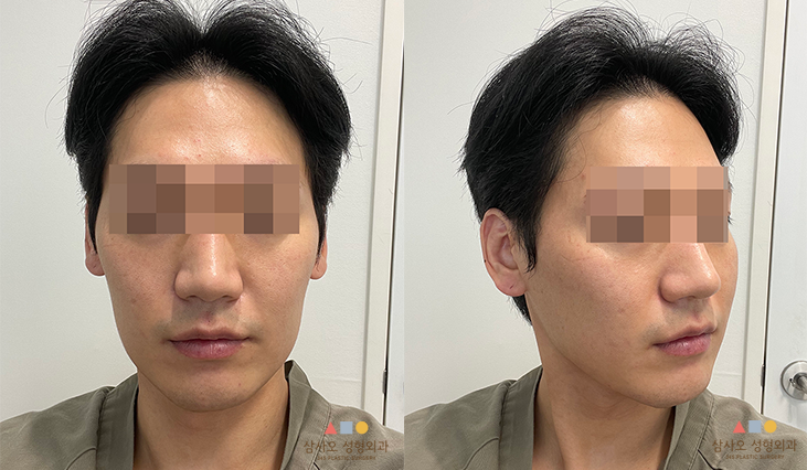 수술 전