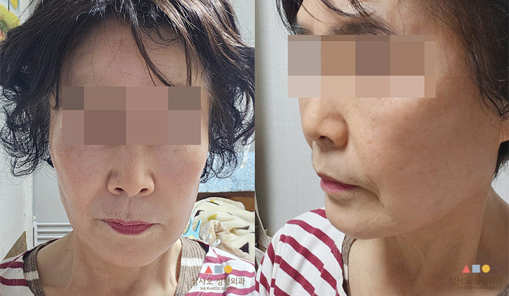 수술 후