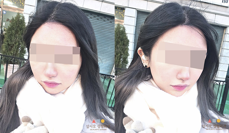 수술 후