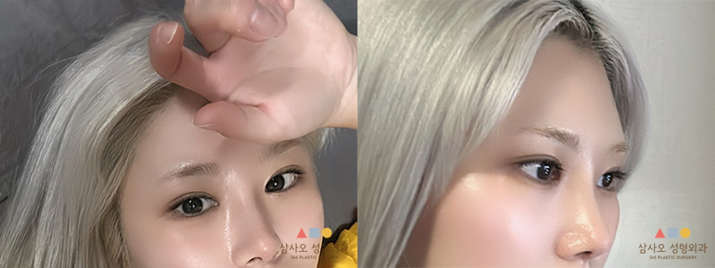 수술 후