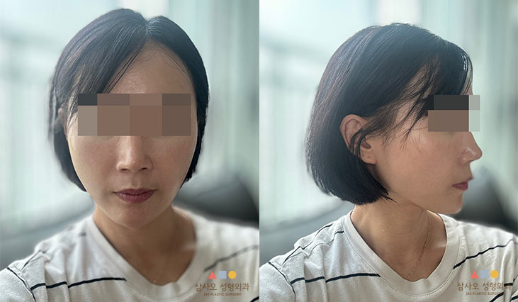 수술 후