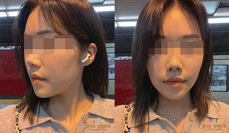 수술 후