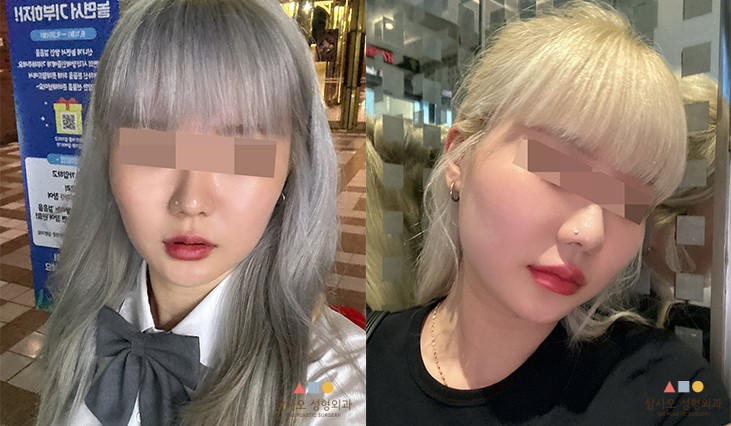 수술 전