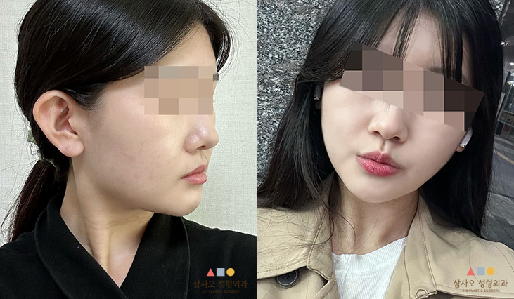 수술 후
