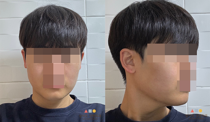 수술 후