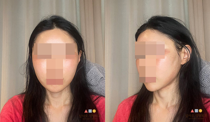 수술 후