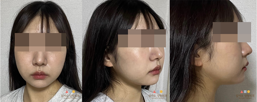 수술 후