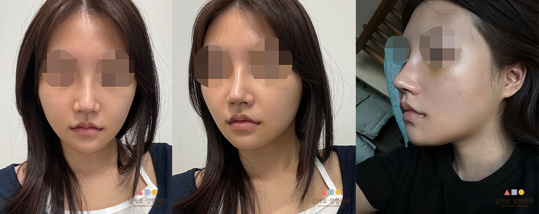 수술 후
