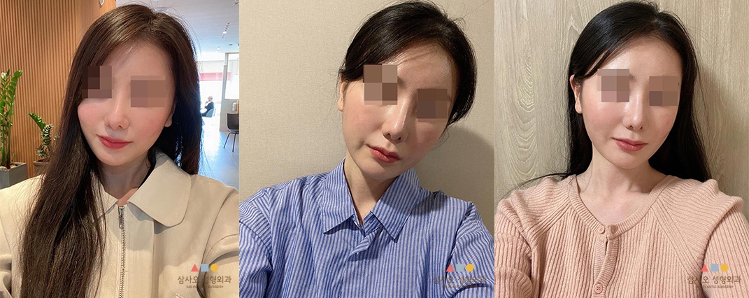 수술 후