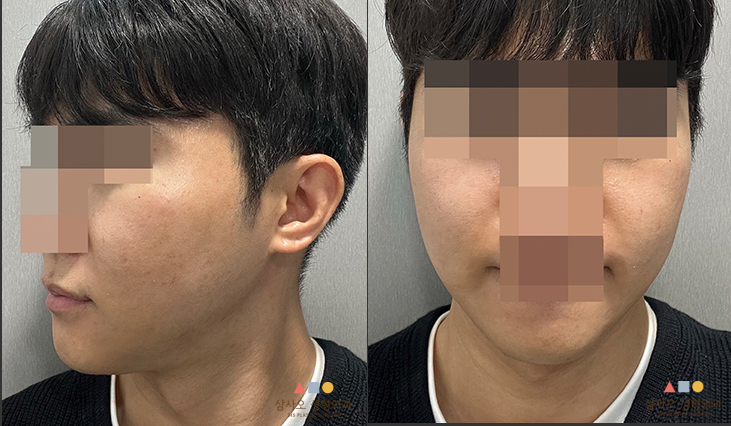 수술 후