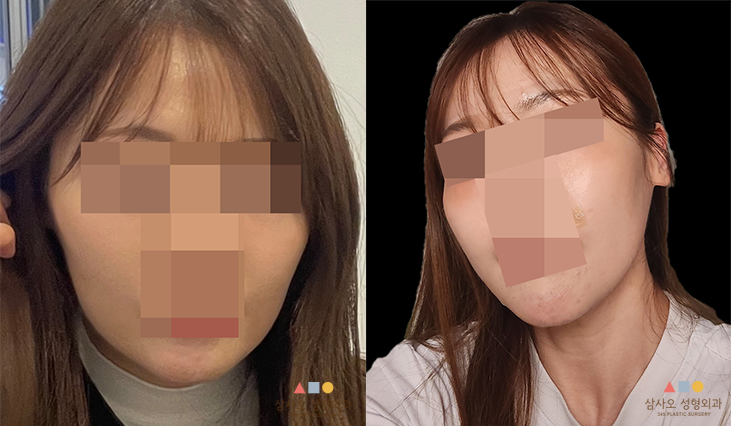 수술 전