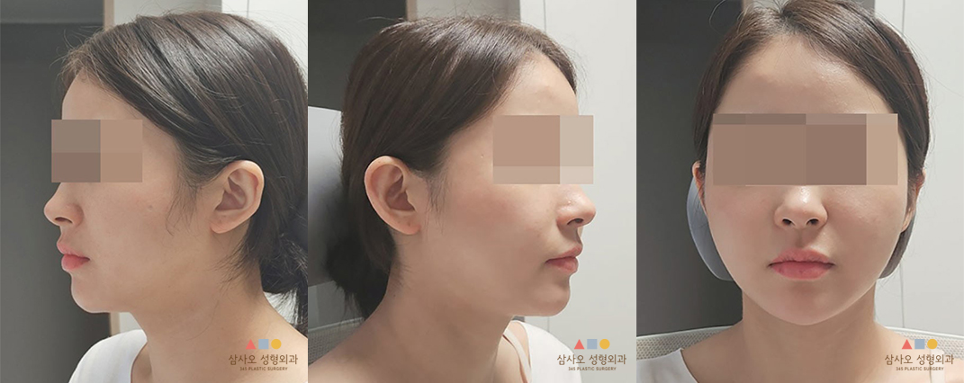 수술 후
