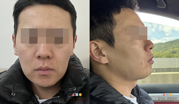 수술 전