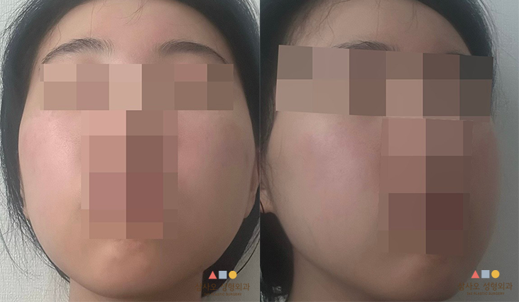 수술 후