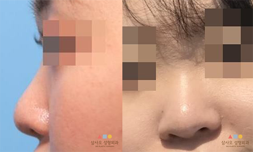 수술 전