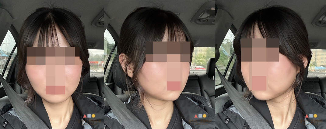수술 후