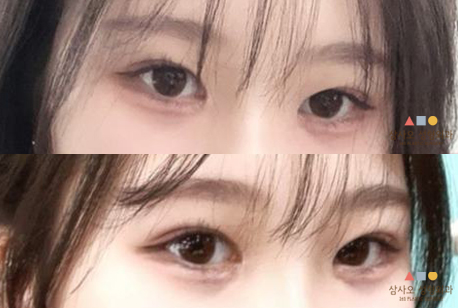 수술 후