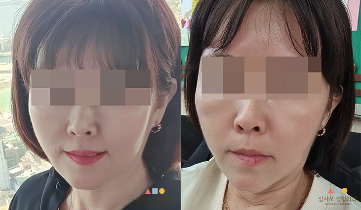 수술 후