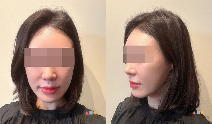 수술 후
