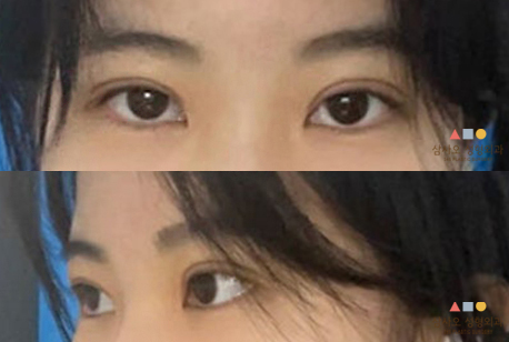 수술 후