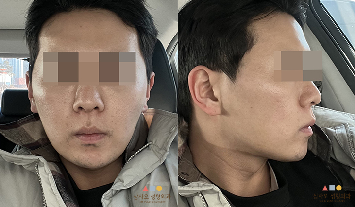 수술 후