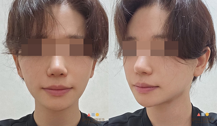 수술 후