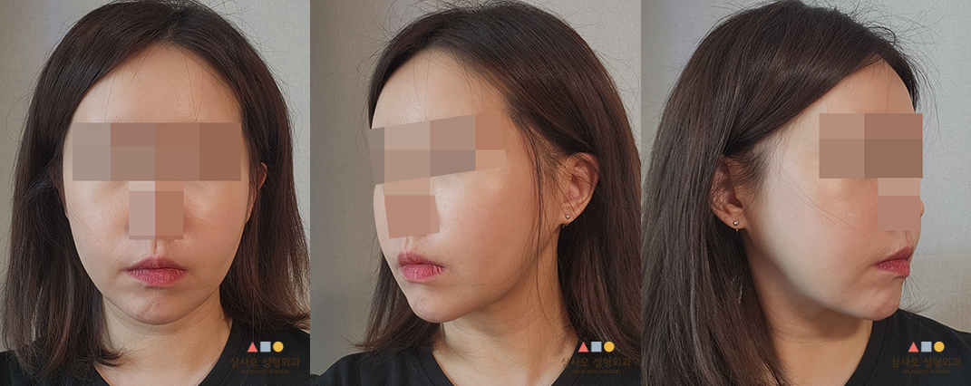 수술 후